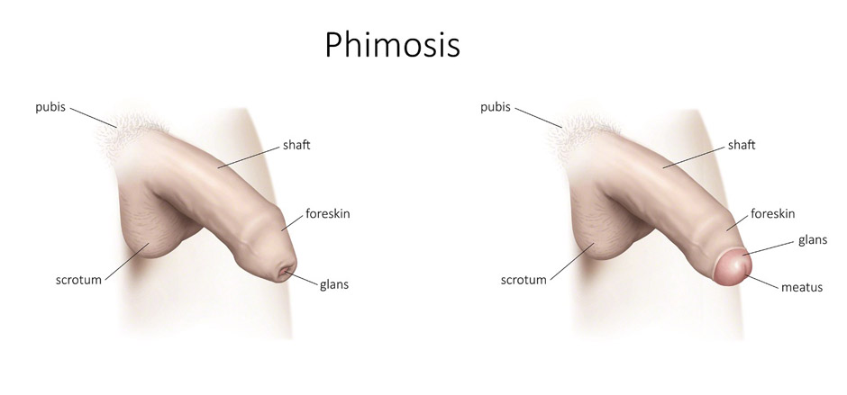 Phimosis treatment